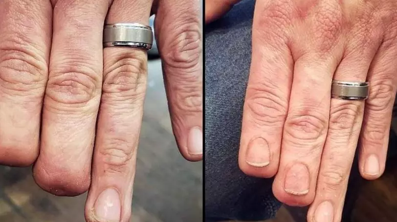 Tattooist Restores Nails On Man Who Lost Two Fingertips