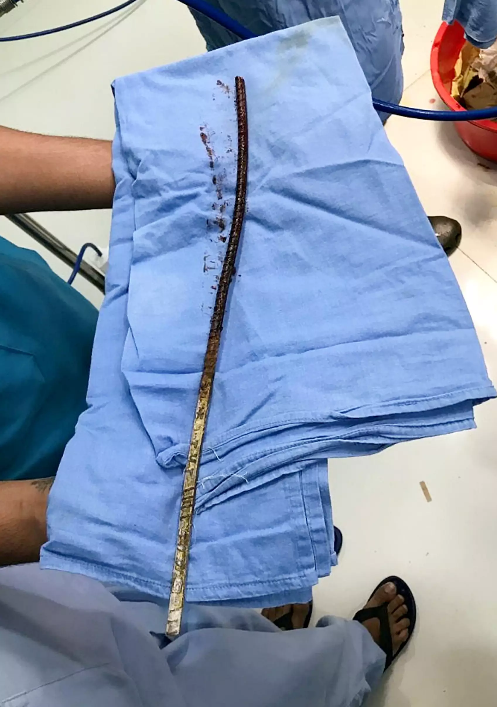 The rod after it was removed from the patient's head.