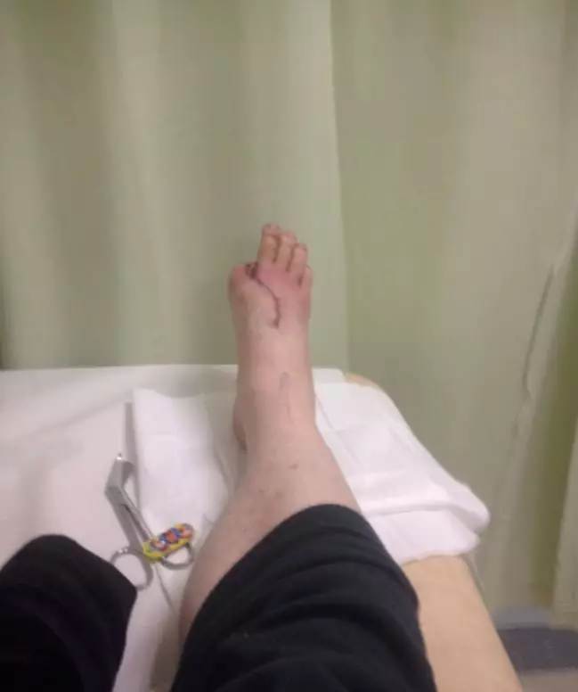 Doctors replaced his thumb with his big toe.