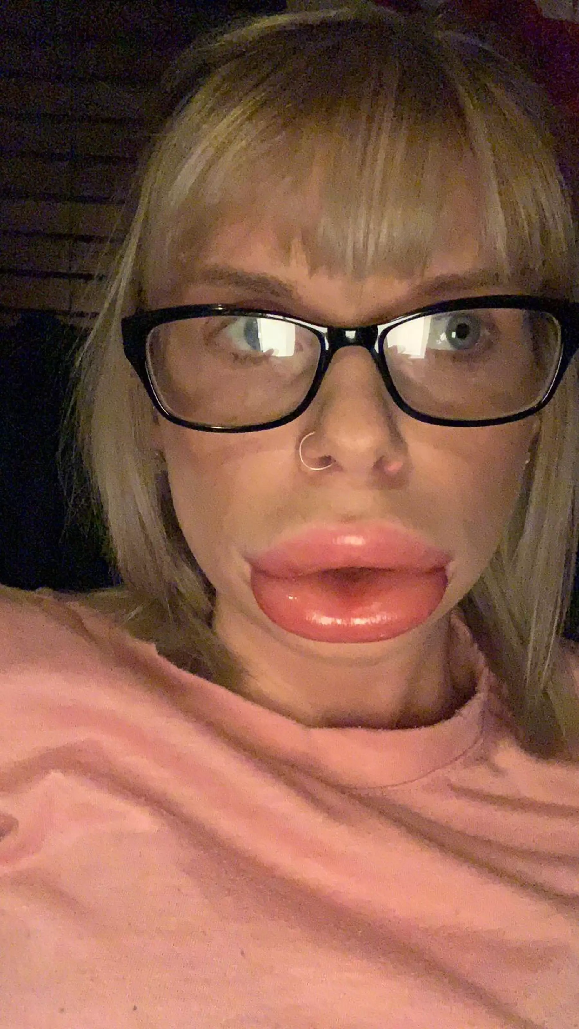 Christina when her lips swelled 'out of control'.