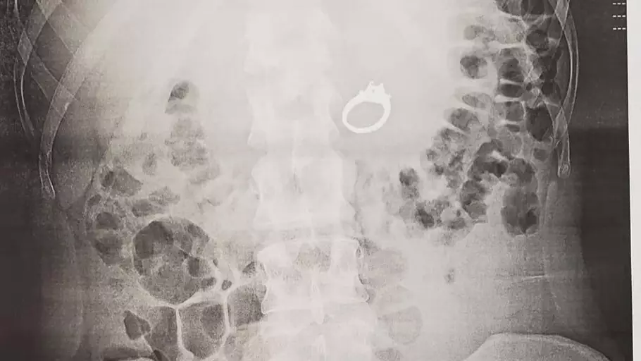 Woman Accidentally Swallows Her Engagement Ring In Her Sleep And Has To Undergo Surgery To Retrieve It From Her Stomach 