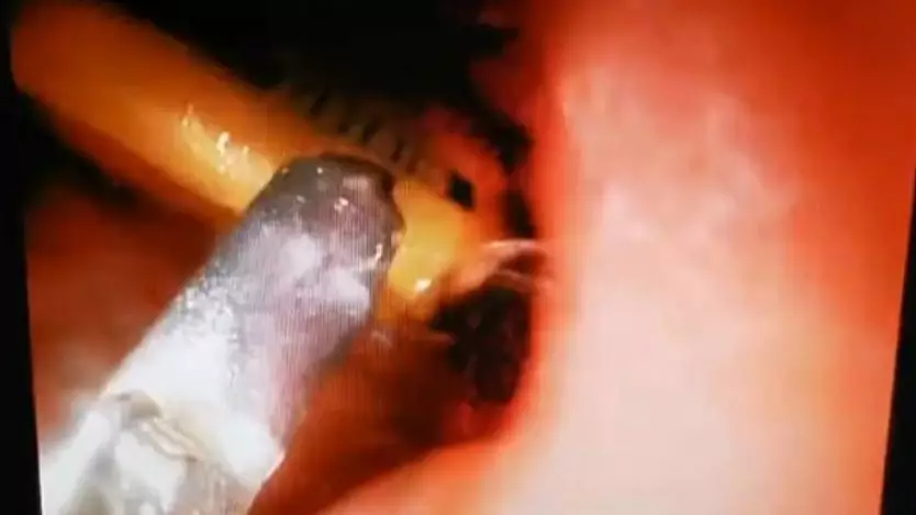 Man Swallowed Lighter That 'Could Have Exploded At Any Time'