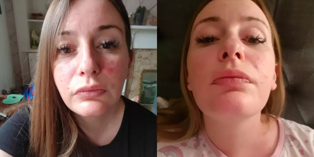 Rosie's skin before using the product, left, and after, right (