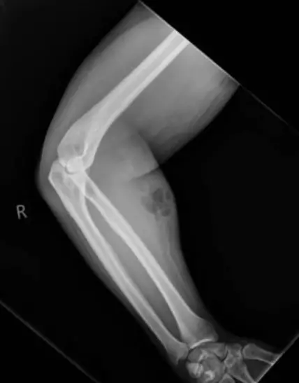 An x-ray of the mans arm.