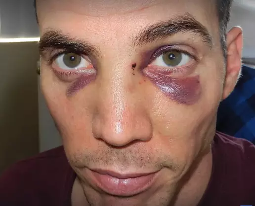 Steve-O the morning after Tyson had broken his nose. (Image