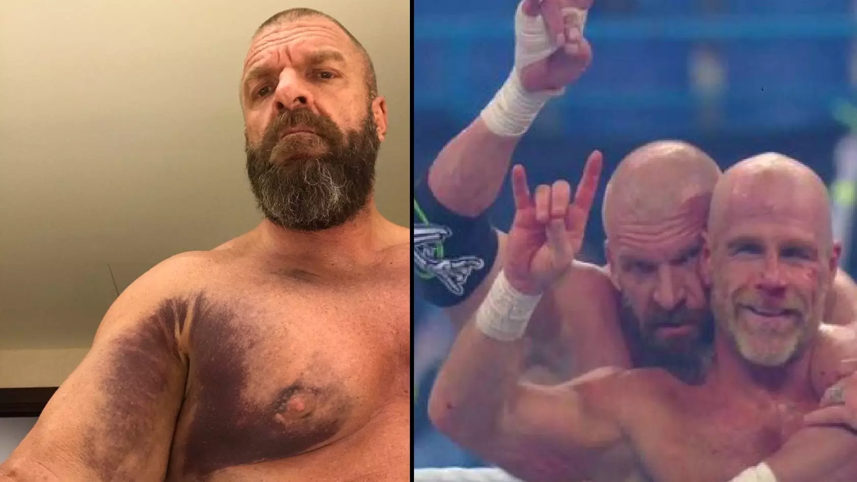 Triple H Shares A Grim Picture After Ripping His Pectoral Muscle