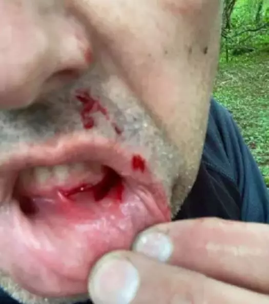 Neil's mouth injury.