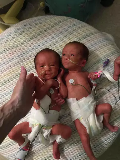 The twins shortly after they were born.