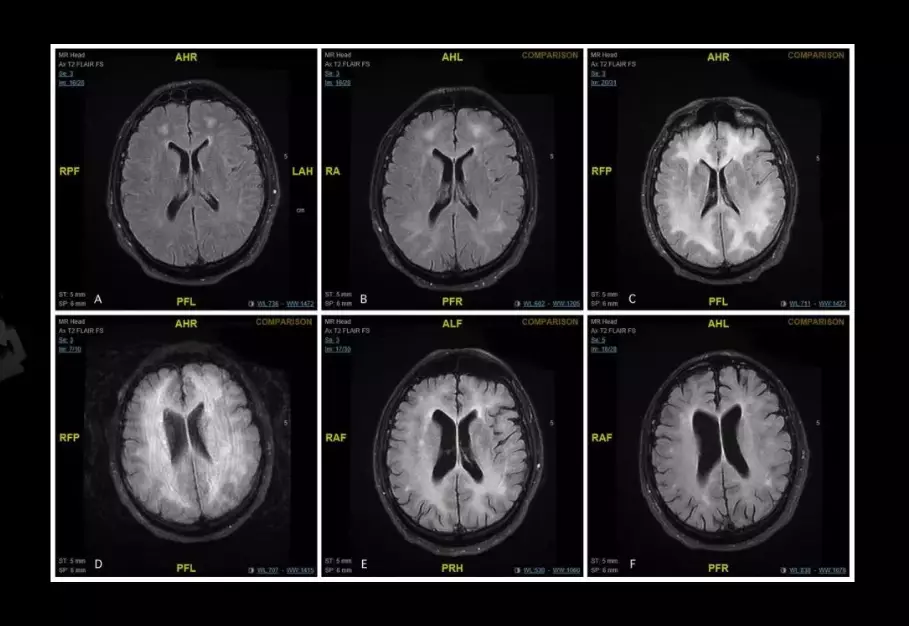 The brain scans show the white matter in the brain being damaged.