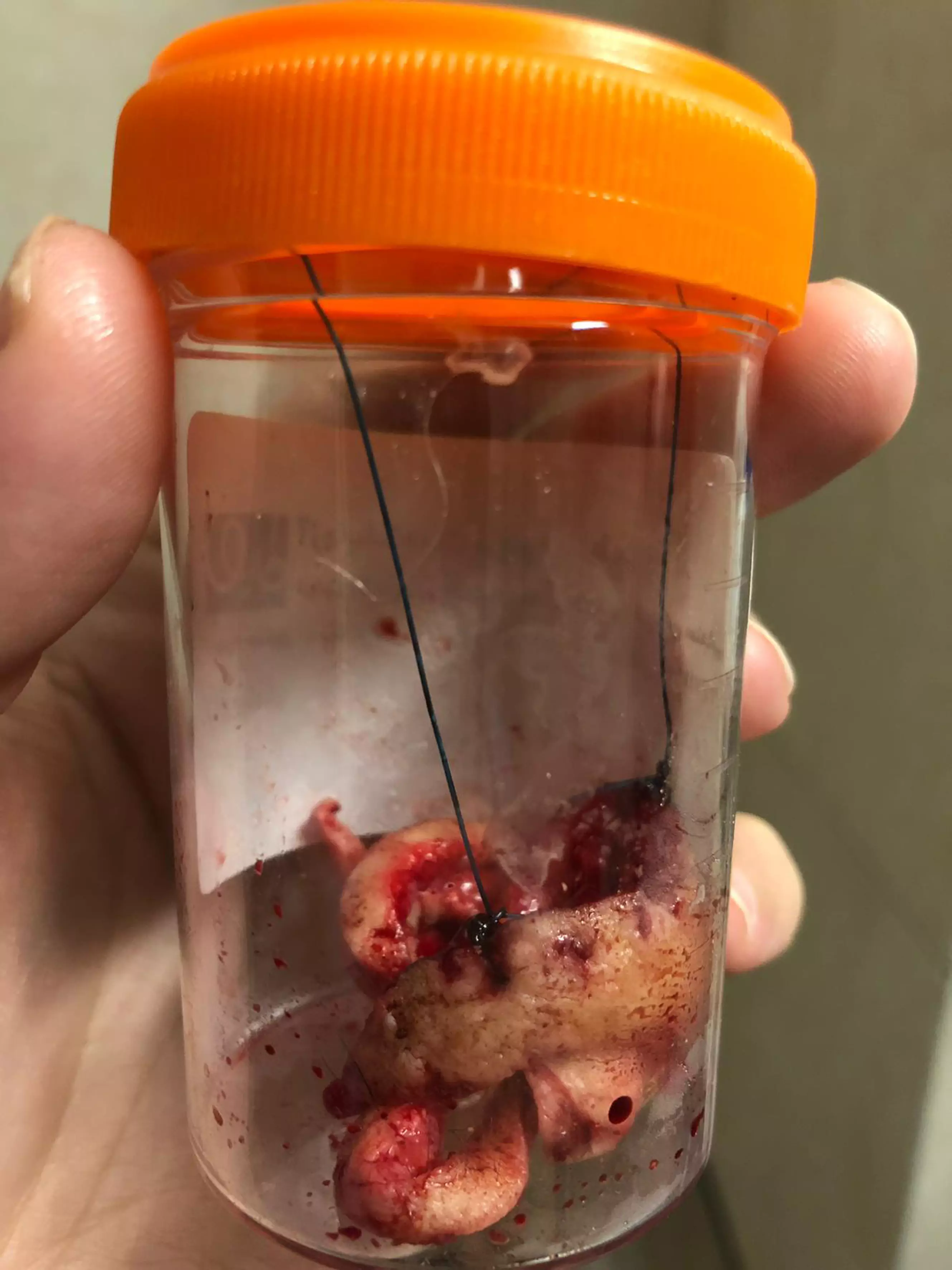 5cm of skin was removed, shown here, along with 200 dissolvable threads and fibrosis.