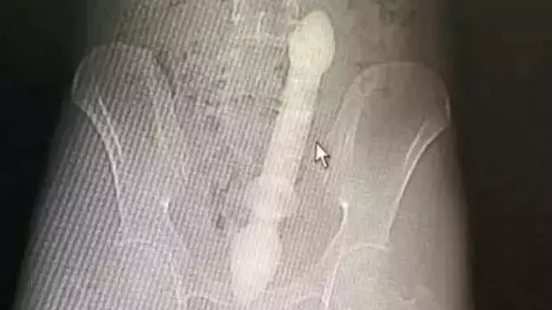 Man Has Emergency Operation After Inserting 20cm Glass Rod In His Anus