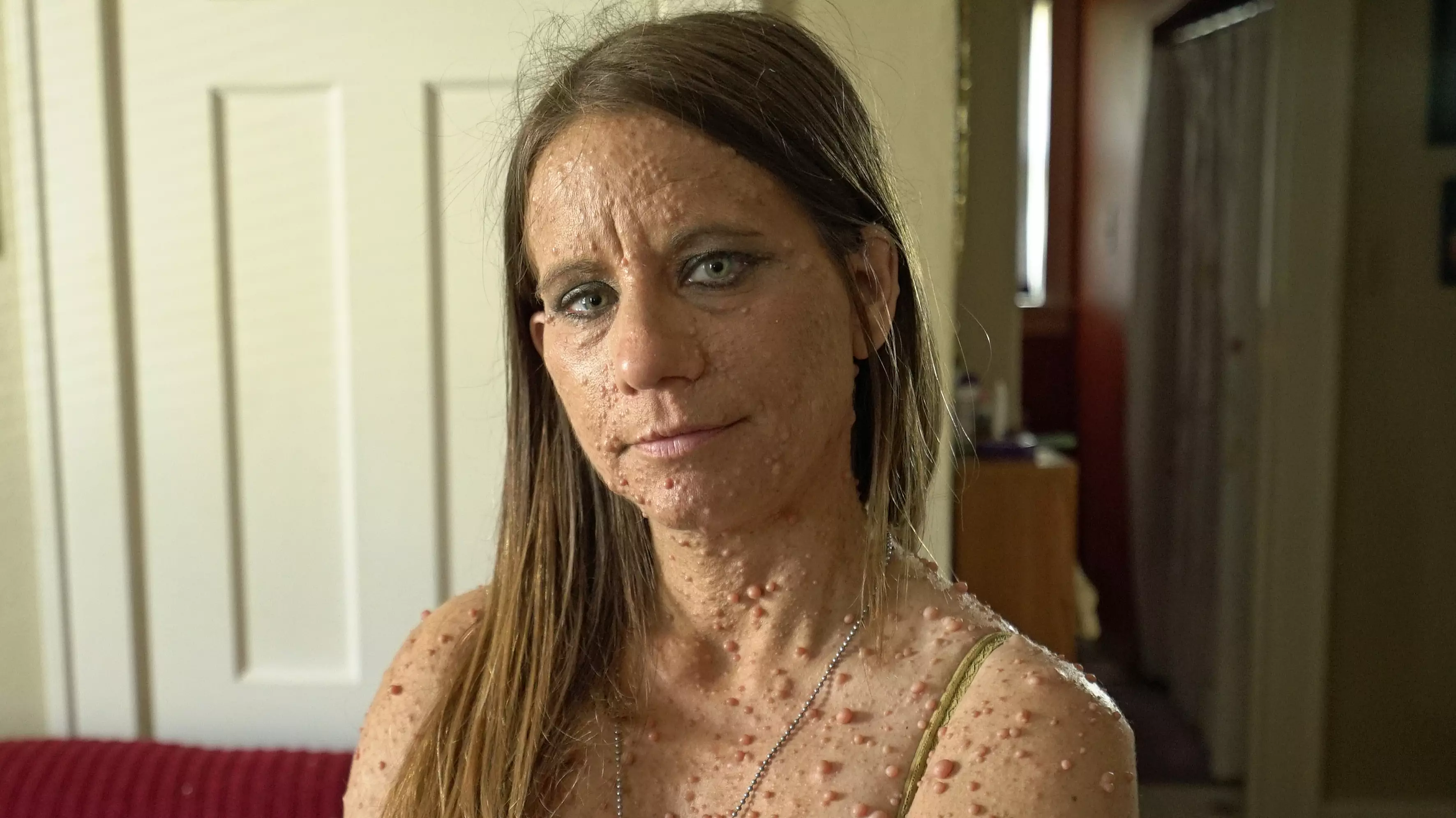 Woman Undergoes Surgery To Remove Hundreds Of Tumours Over Body 