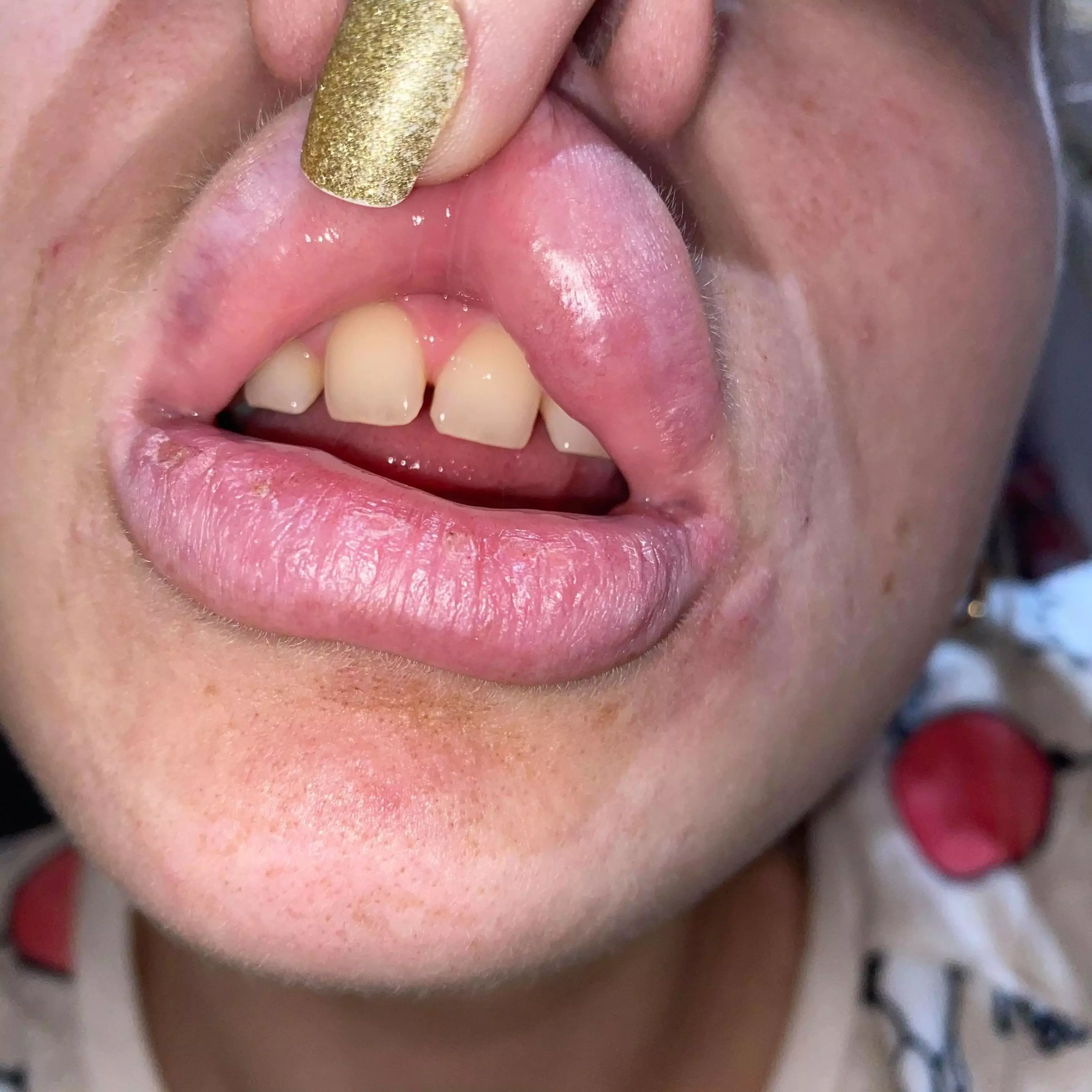 The full-time mum is sharing her ordeal in a bid to urge people to be careful when they get lip fillers (