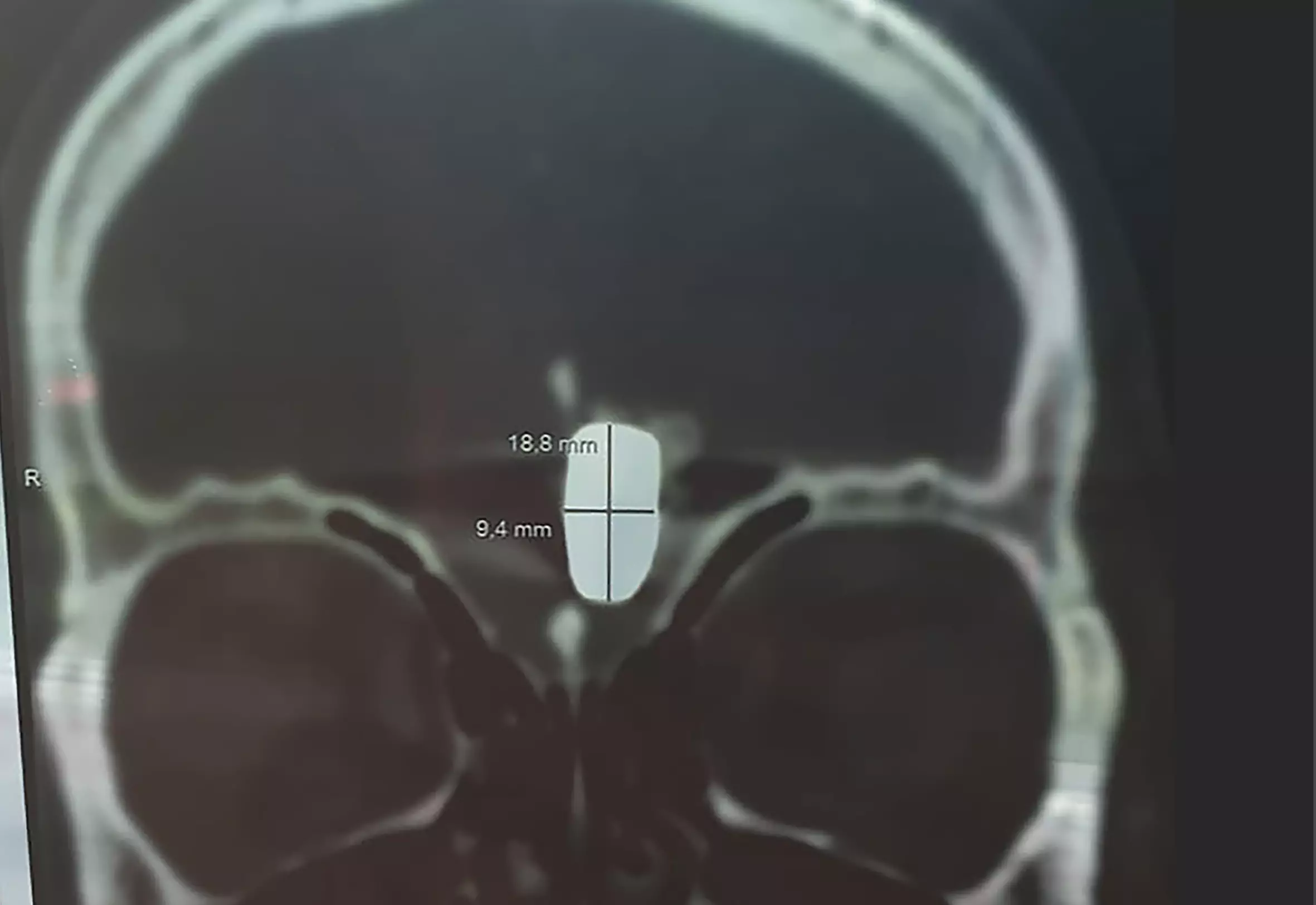 The bullet inside Mr Krutov's head.