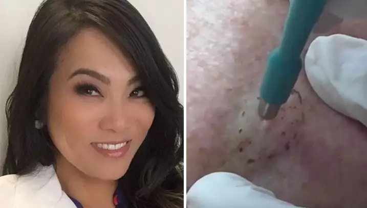 Dr Pimple Popper Pops Two-Year-Old Bump On Woman's Back