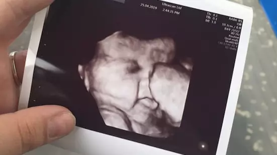 Little Maya's hair even showed up on her scan (
