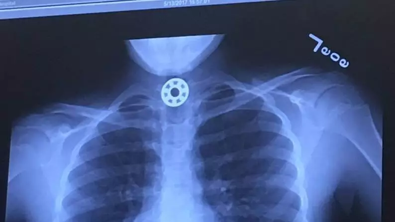 Girl Needed Surgery After Getting Part Of Fidget Spinner Stuck In Throat 
