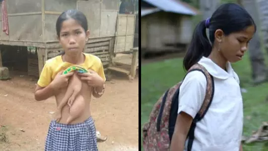Schoolgirl Born With Extra Arms On Her Torso To Have Them Removed