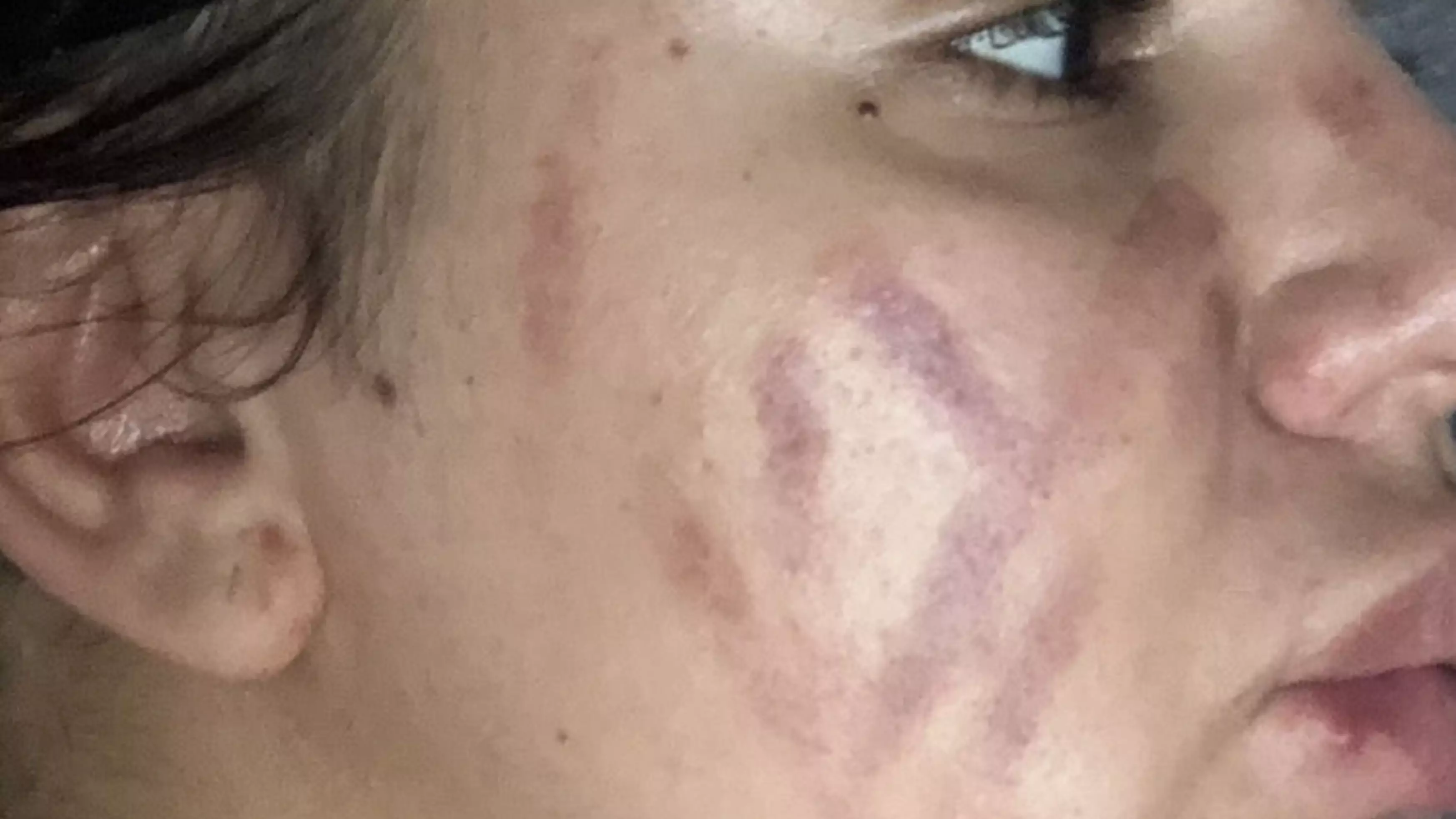 Student Left With Severe Bruises After Using Blackhead Remover