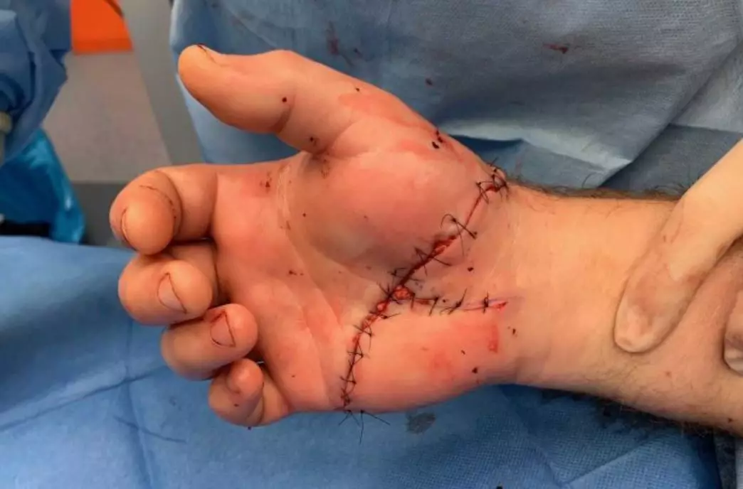 Surgeons worked for seven hours to save his hand.