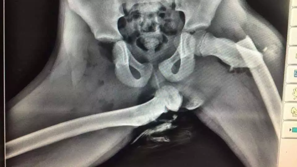 Horrific X-Ray Image Shows Woman's Hip After Crashing With Her Feet On Dashboard