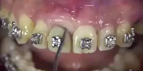 Why Not Watch This Horrible Video Of Someone Having Their Tooth Removed?