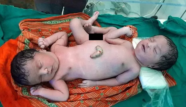 Heartbreaking Story Of Conjoined Twins Born Sharing 'Nearly Every Organ'