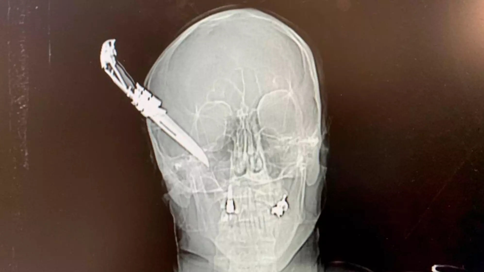 Gruesome X-Ray Shows Knife Sticking Out Of Man's Head After Attack