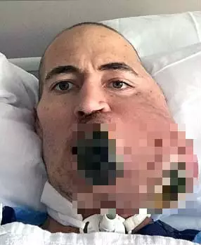 Man with tumour