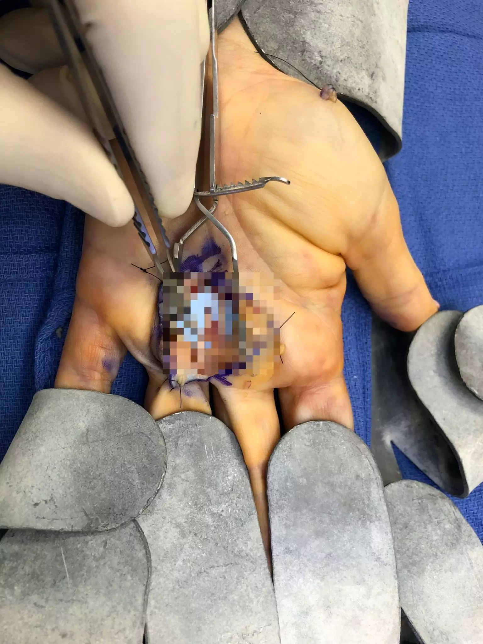 Melissa's hand during surgery.