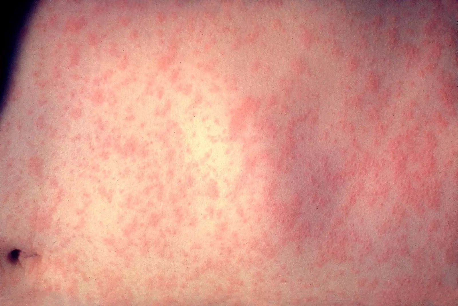 Measles can cause a red rash to break out after just a few days of infection.