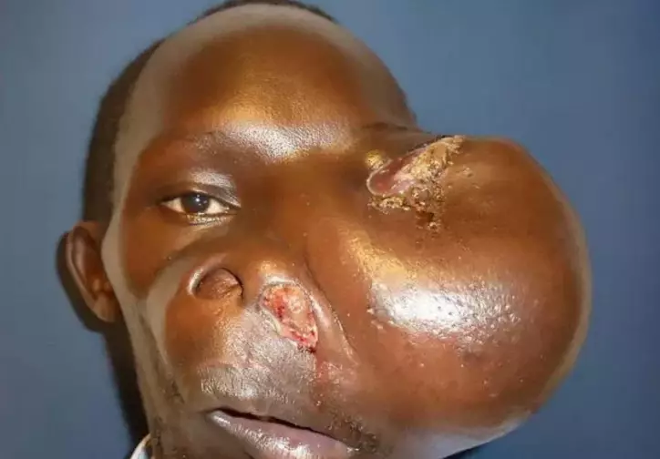 Man With Massive Tumour On His Face Gets It Removed