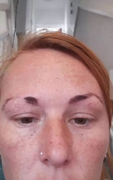 Colline said it took her eyebrows nine months to recover.