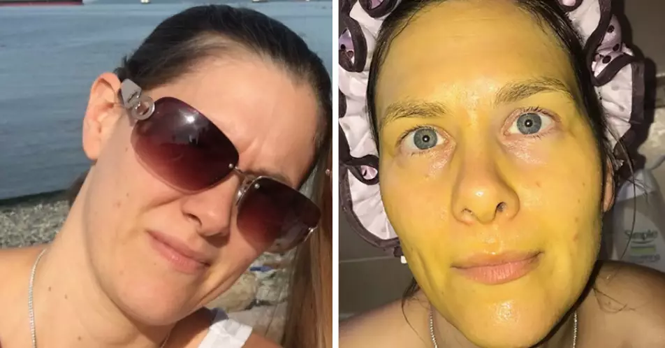 Woman Left With Bright Yellow Skin After DIY Face Mask Fail
