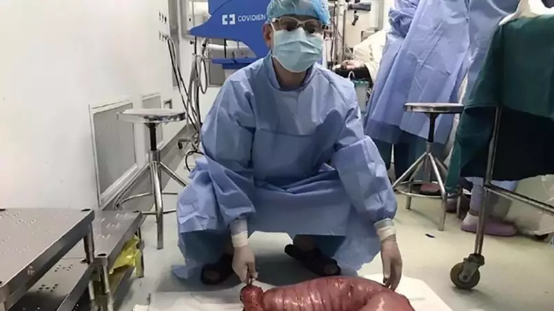 Surgeons In China Remove 30 Inches Of Constipated Man's Intestines