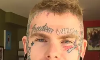 Man Gets Tattoo Removed By Slicing The Skin Off His Forehead