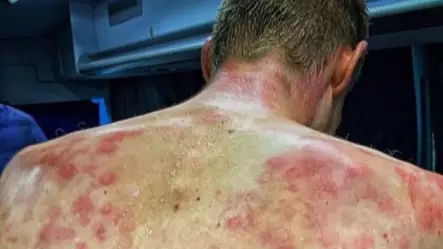 Cyclist Shows Off Bruised And Battered Back After Riding Through Hailstorm