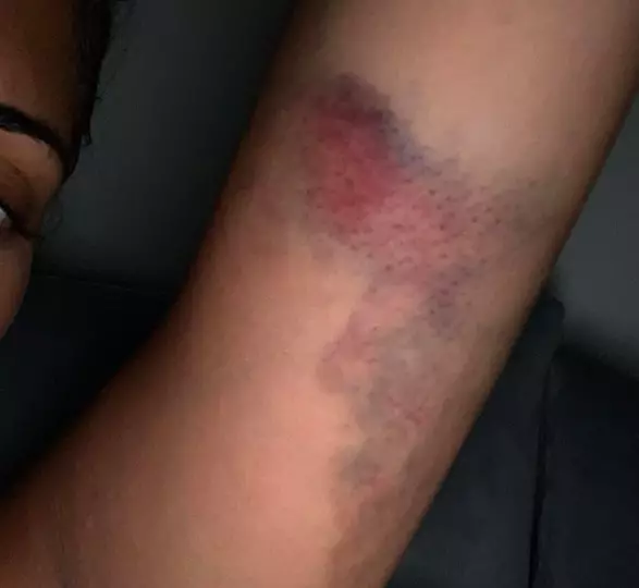 Malin Andersson shared her bruised arm with Instagram followers to raise awareness