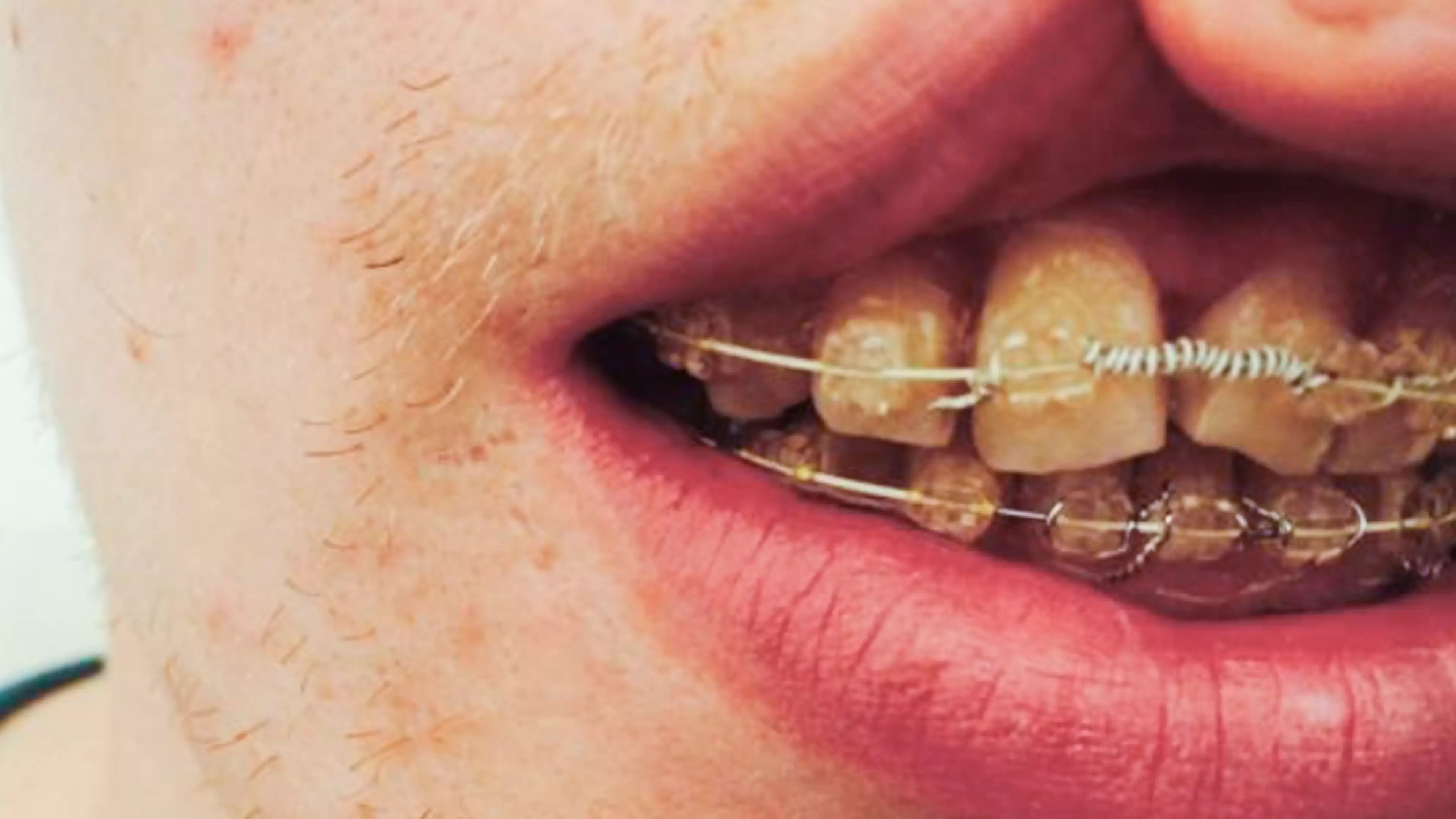 Man Receives Payout After Being Left With Yellow Twisted Teeth