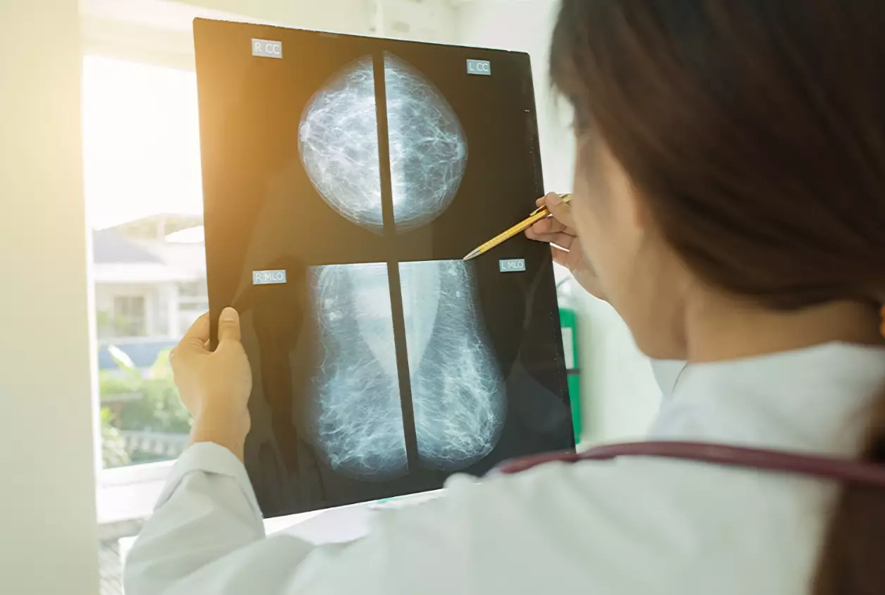 Around one million breast screenings have been cancelled this year (