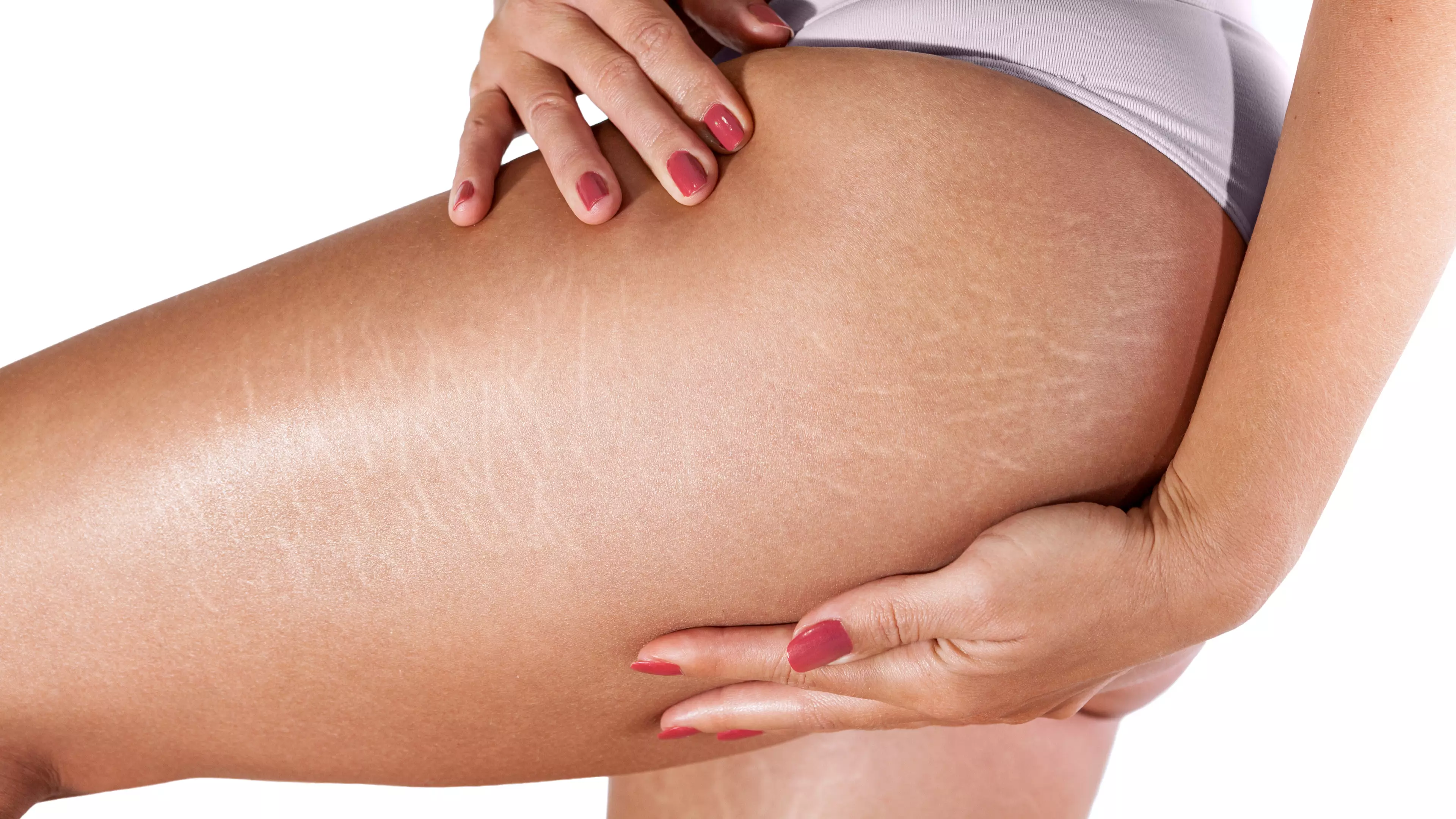 Man Claims Women With Stretch Marks Should Be 'Ashamed' Of Their Bodies