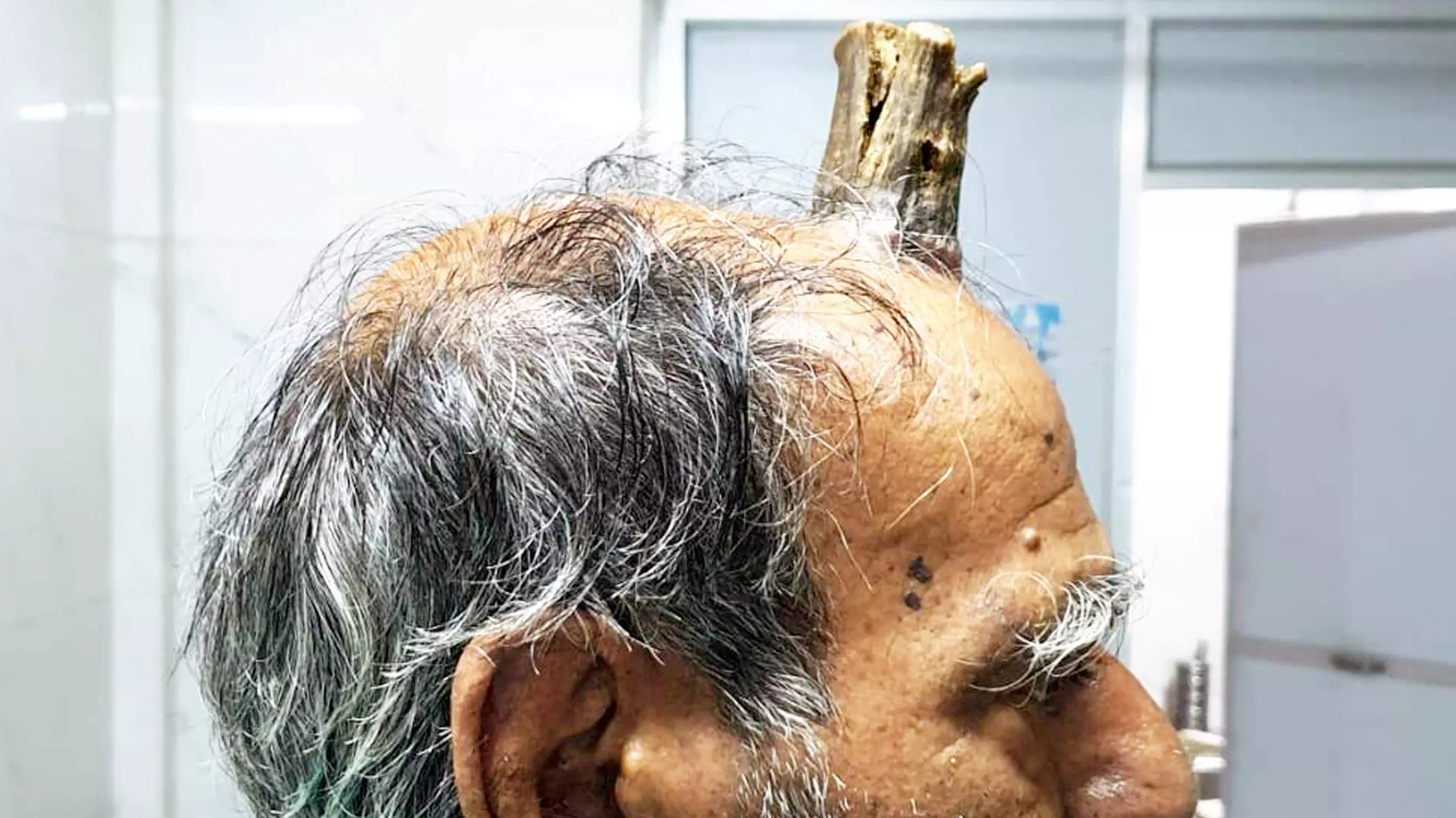 Surgeons Remove Four-Inch 'Devil Horn' From Farmer's Head 