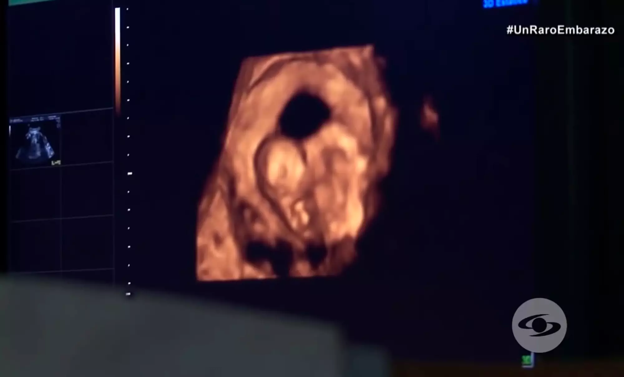 Doctors detected something in the baby's stomach during pregnancy.