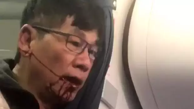 United Airlines Passenger's Injuries Revealed By Lawyer