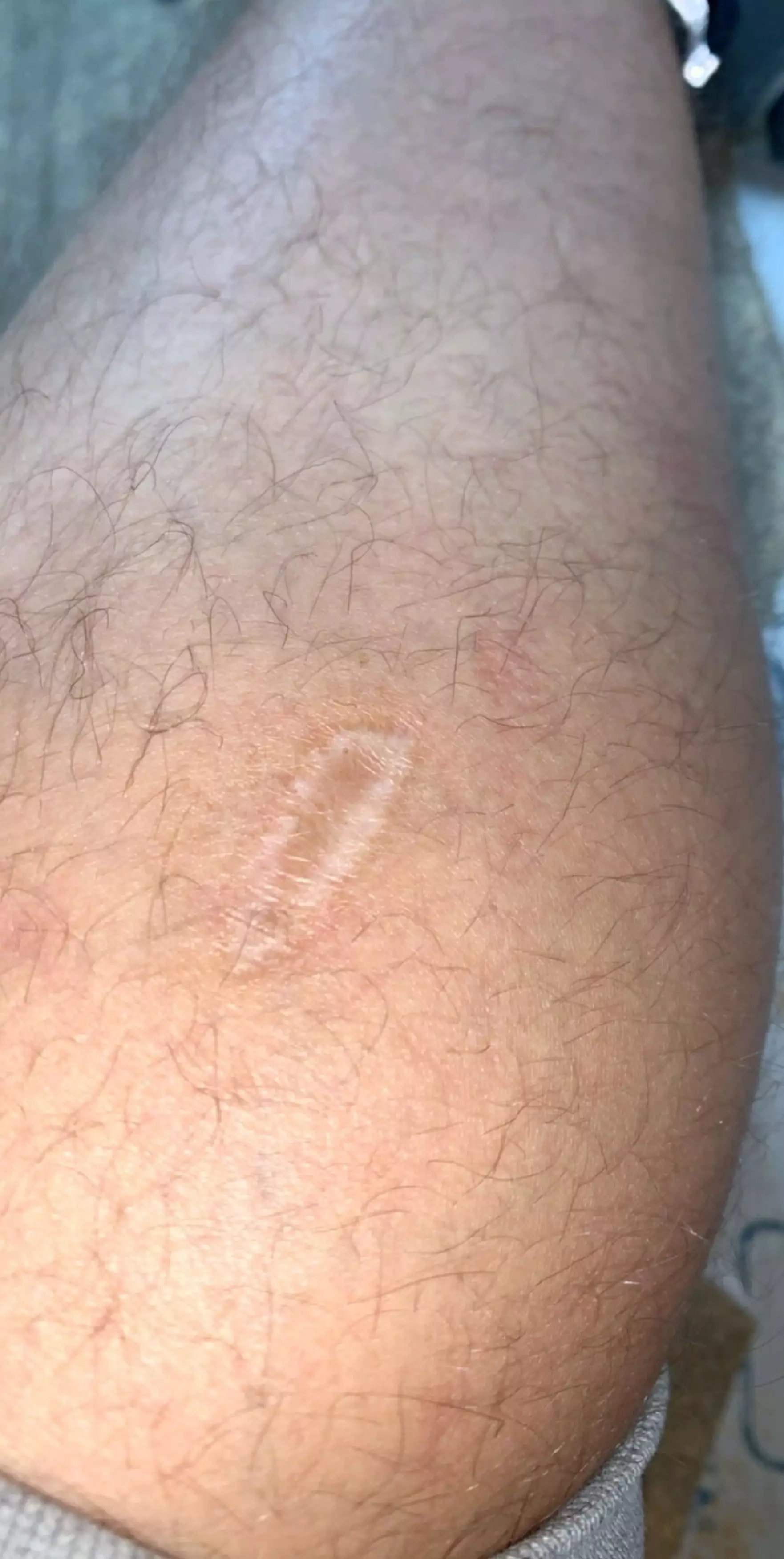 Christopher still has a scar following surgery.