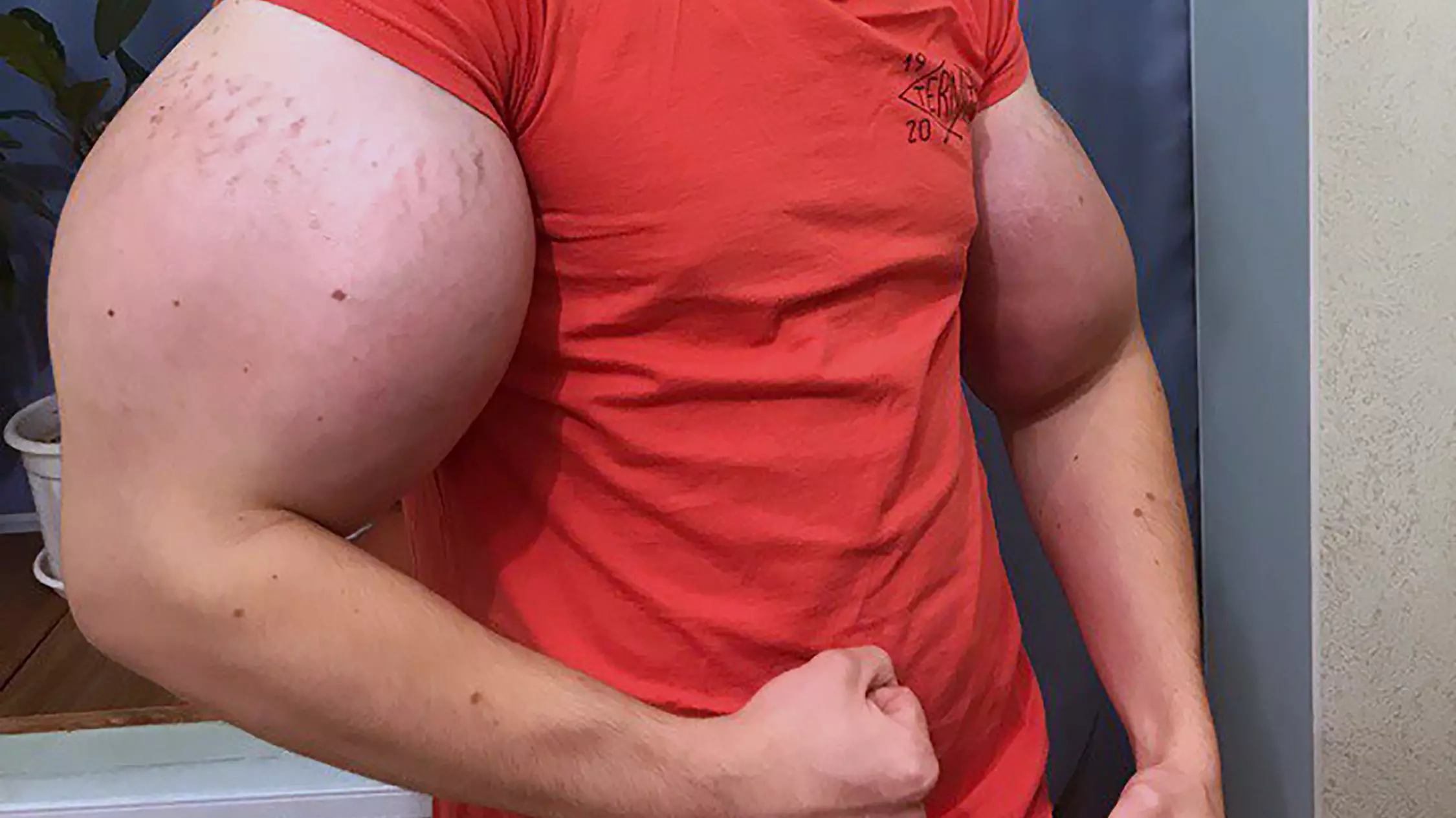 ​Man With Huge 'Popeye' Arms Could Lose Them, According To Doctors