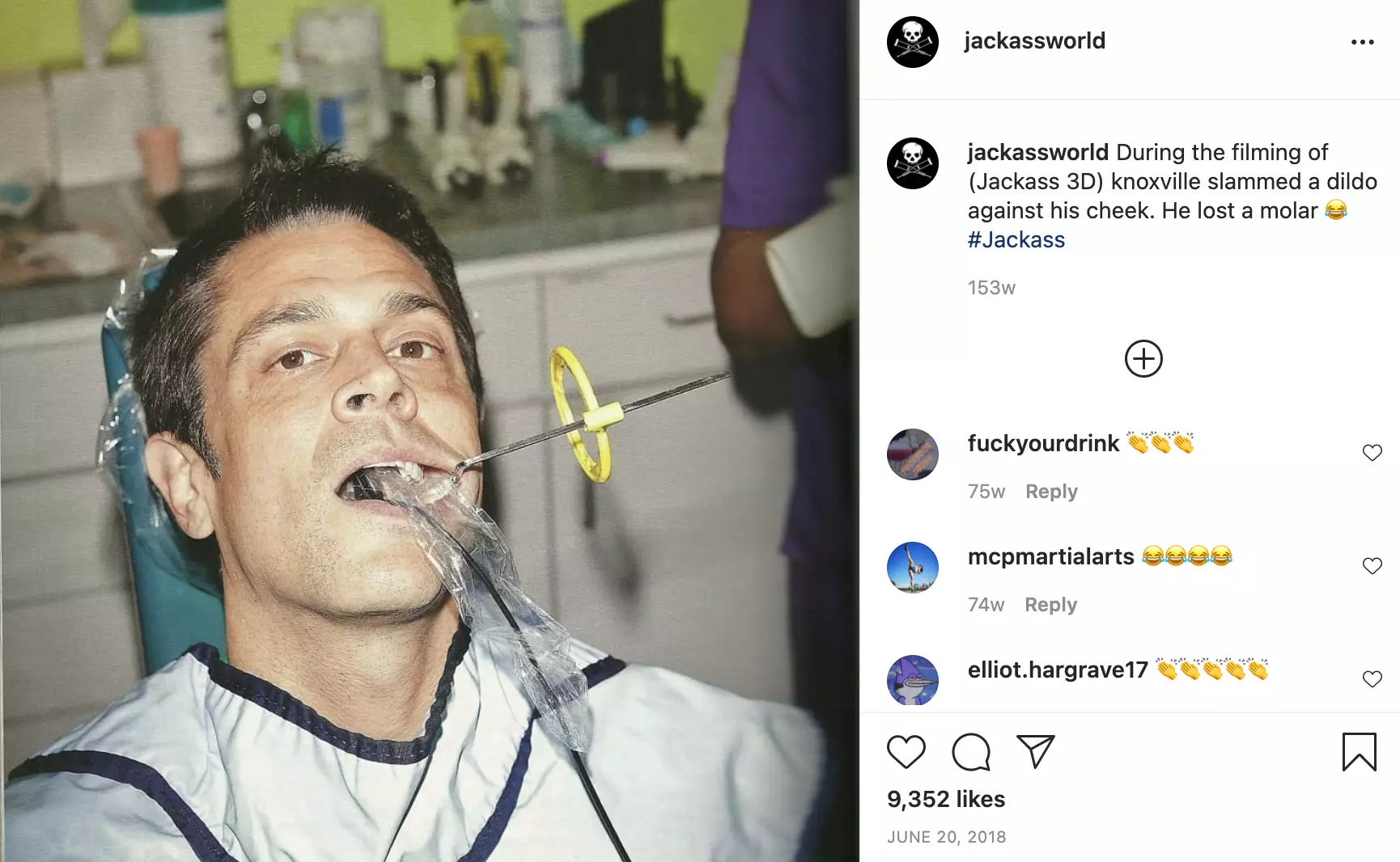 Johnny Knoxville lost a molar during the filming of Jackass 3 (Credit:Instagram/jackassworld)