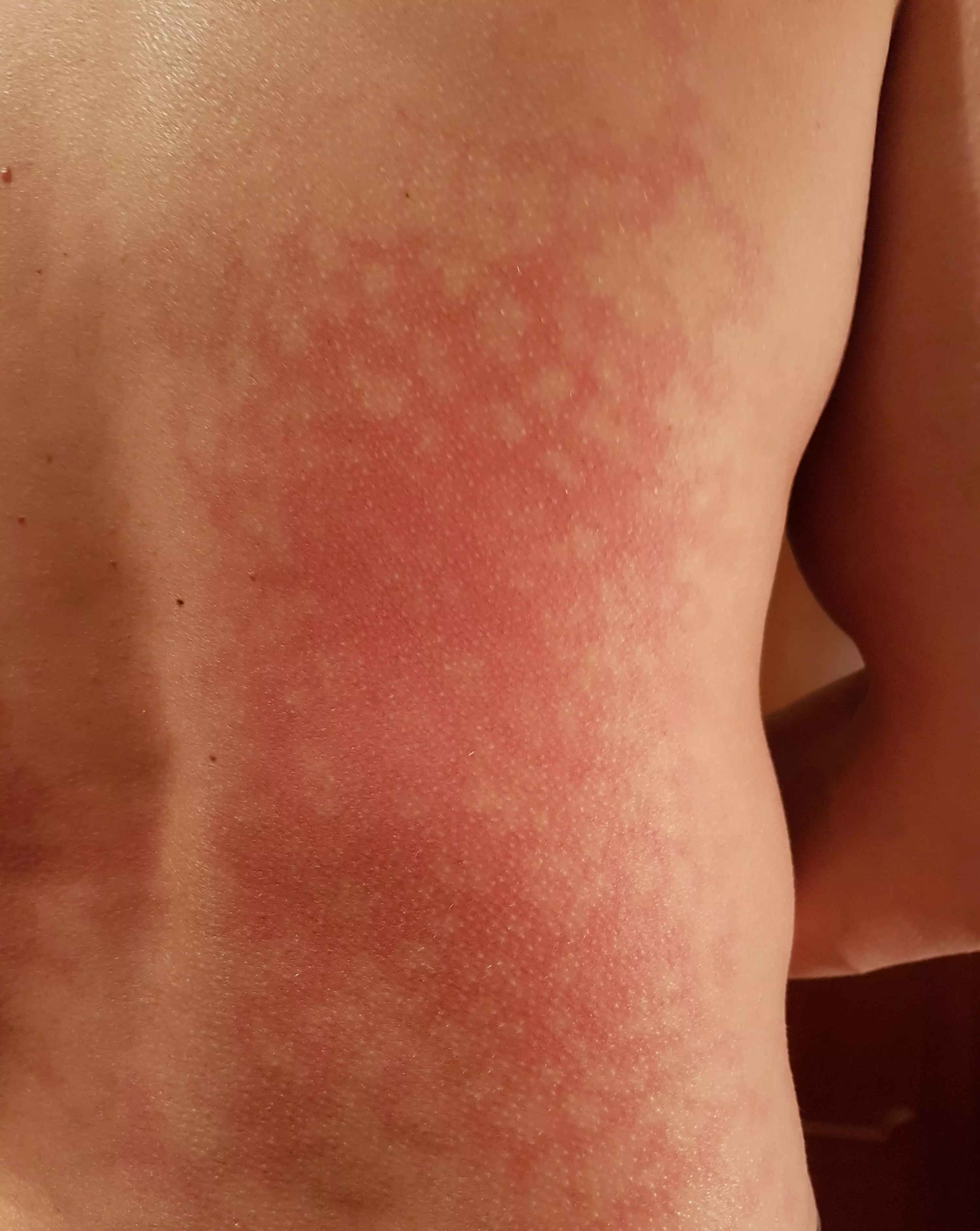 It's not a burn, but a blotchy rash caused by intense heat (