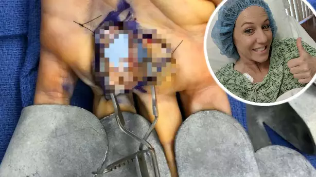 Woman Severs Nerve And Slashes Artery After Plunging Knife Into Hand While Cutting Avocado
