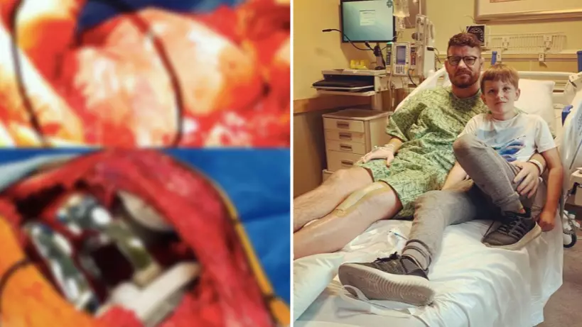 Michael Bisping Shares Graphic Images Of His Knee Surgery That Will Make Your Stomach Churn
